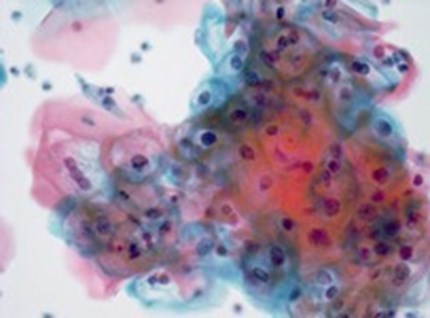Plaveiselepitheelcellen met HPV kenmerken
