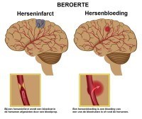 Herseninfarct