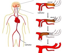 Intra arteriele trombectomie